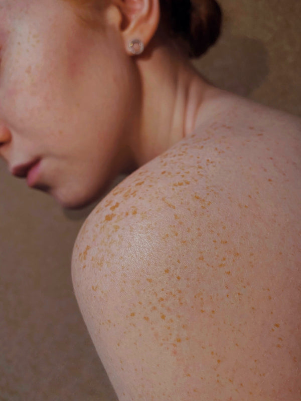 Hyperpigmentation- why is it caused and how to treat it? Vana Botanicals